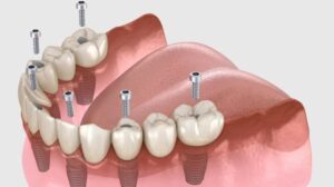 All-on-6 implant