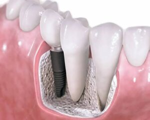 Çene kemiği yetersizliğinde implant
